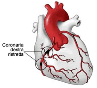 Coronary arteries