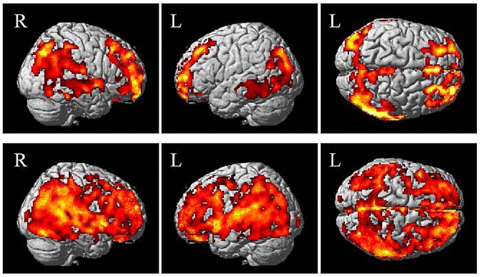 Aree del cervello con beta-amiloide. Prima riga: anziani cognitivamente normali senza declino soggettivo della memoria. Seconda riga: anziani con aumento della deposizione di amiloide e declino della memoria.