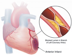 Atherosclerosis heart compromise