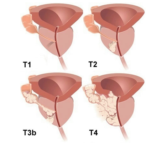 Prostate cancer
